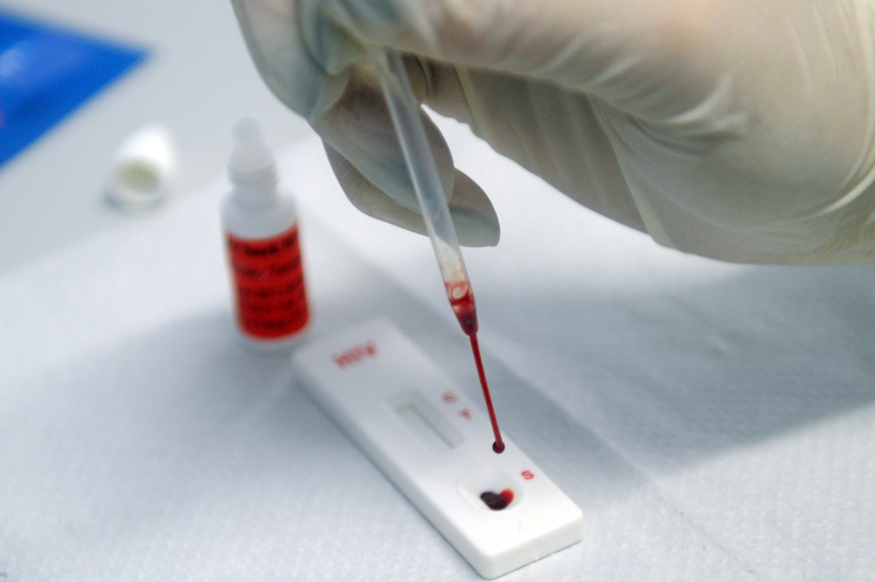 Governo suspende exames de HIV, Aids e hepatites virais no SUS