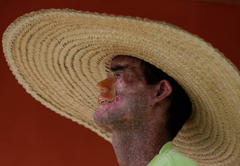 Em Faina, 114 portadores de xeroderma pigmentoso, doença rara, reclamam de descaso