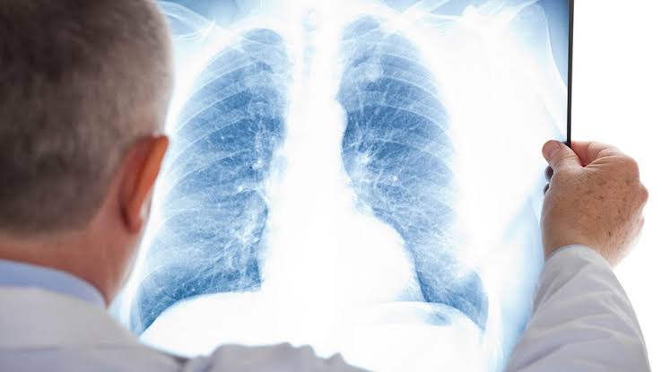 HGG oferece exame gratuito de pulmão nesta quinta-feira