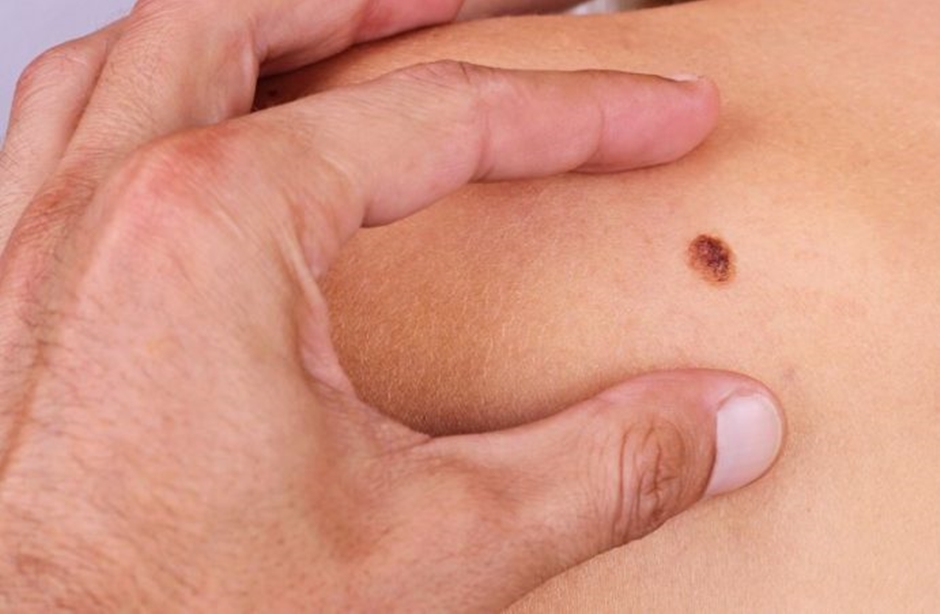 UFF ensinará técnica que permite 100% de cura em cânceres de pele
