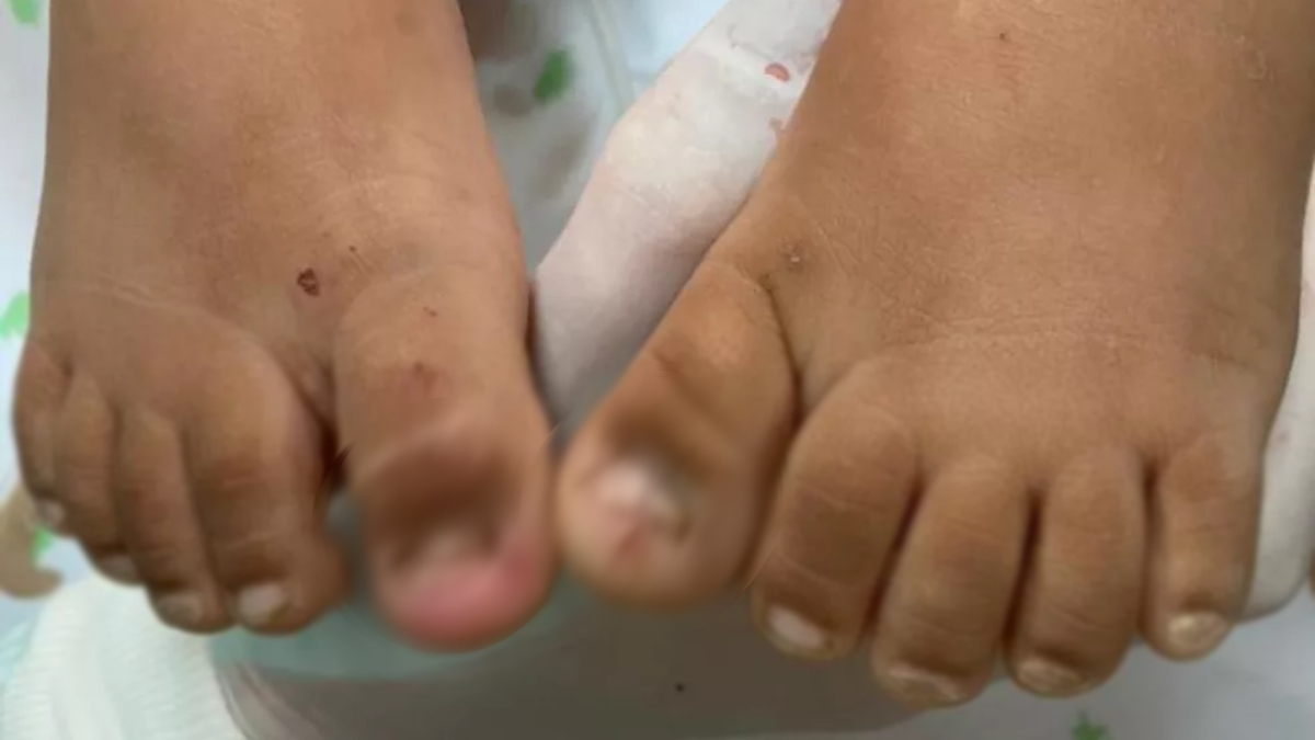 Menina de 2 anos foi levada a um hospital de Goiânia sem duas unhas e com ferimentos pelo corpo, inclusive, no intestino
