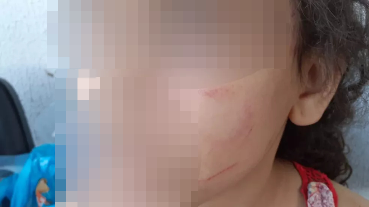 Menina com rosto borrado tem hematoma no rosto. Foto ilustra chamada: Padrasto é suspeito de agredir menina de 6 anos após ficar bêbado em Goiânia