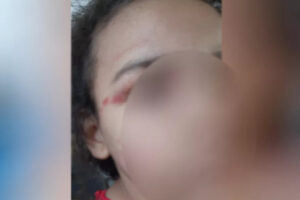 Menina com rosto borrado tem hematoma no rosto. Foto ilustra chamada: Padrasto é suspeito de agredir menina de 6 anos após ficar bêbado em Goiânia