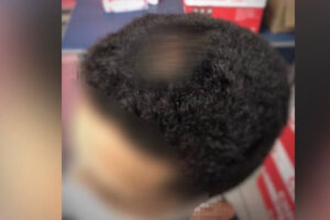 Foto mostra de forma censurada o ferimento causado no couro cabeludo de um rapaz que sobreviveu a dois disparos em Itumbiara. O homem sobrevive