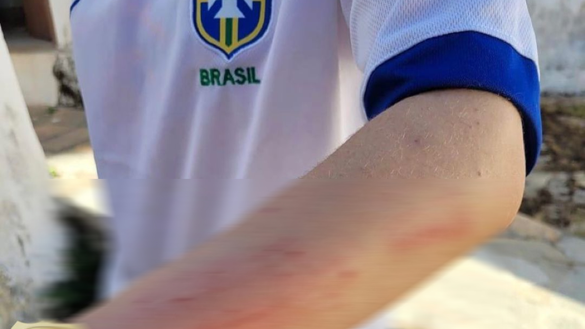 Jovem usa camiseta do Brasil branca, com detalhes em azul. Ela mostra o braço machucado. Pai é suspeito de agredir filha por ela passar mais tempo com a mãe, em Pirenópolis