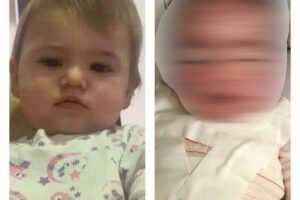Reação alérgica deixa criança de Anápolis com rosto desfigurado