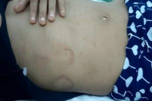 Hematomas na barriga da criança agredida pelo pai e madastra em Aparecida de Goiânia