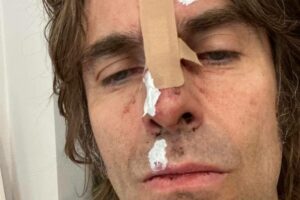 Músico publicou foto exibindo machucados no rosto. Liam Gallagher, ex Oasis, diz ter caído de helicóptero após show