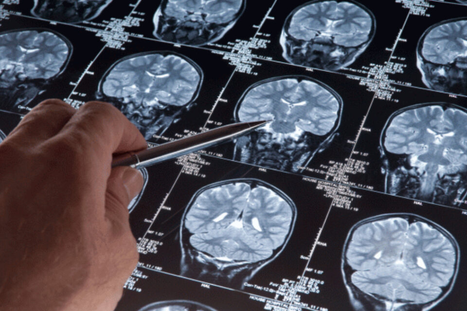 Pacientes com Alzheimer têm até 6 vezes mais risco de contraírem Covid-19 grave