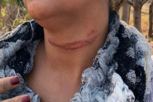 Vítima mostra marcas que ficaram em seu pescoço ao sofrer agressão