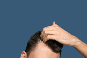 Queda de cabelo é uma das consequências da Covid-19