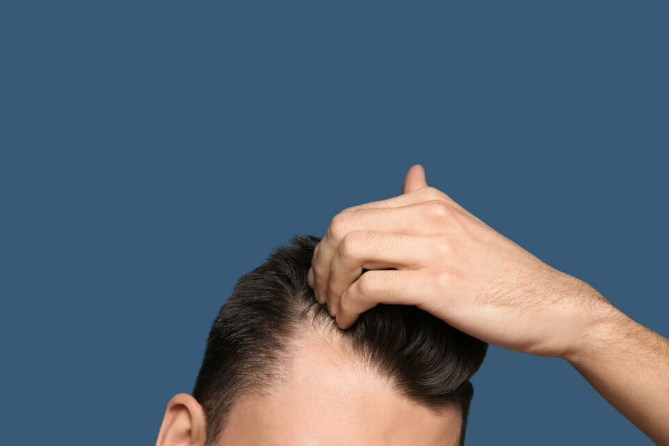 Queda de cabelo é uma das consequências da Covid-19