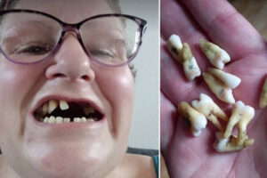 Britânica arranca 11 dentes sozinha depois de tentar saúde pública por 6 anos