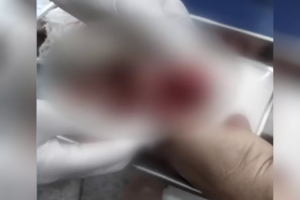 Homem perde parte do dedo após ser atacado por piranhas em lago de Buriti Alegre