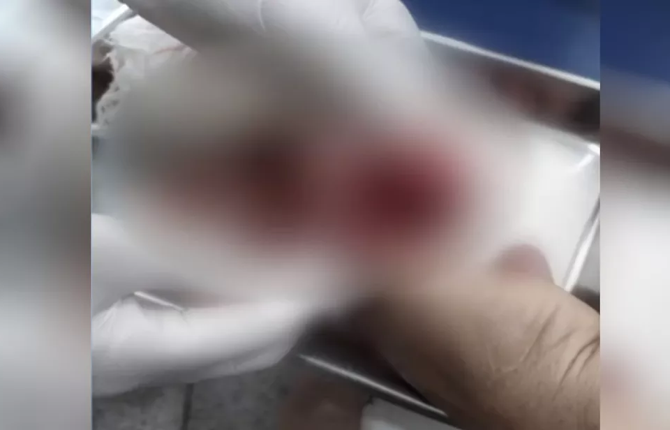Homem perde parte do dedo após ser atacado por piranhas em lago de Buriti Alegre
