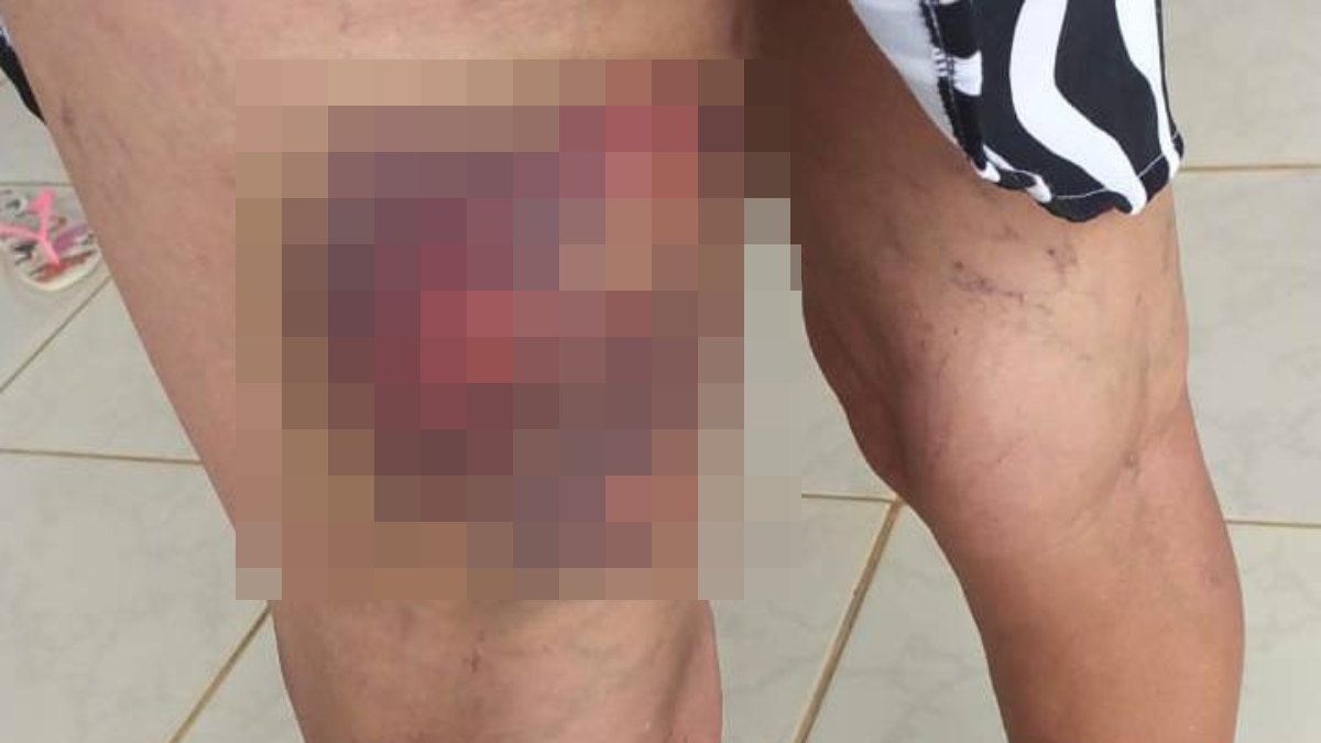Idosa fica ferida após quarto ataque de pitbull em cinco meses, em Goiânia