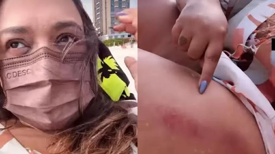 Cantora publicou no instagram imagens da perna com hematoma. Preta Gil é "atropelada" por barraca de praia e se machuca "Toda roxa"