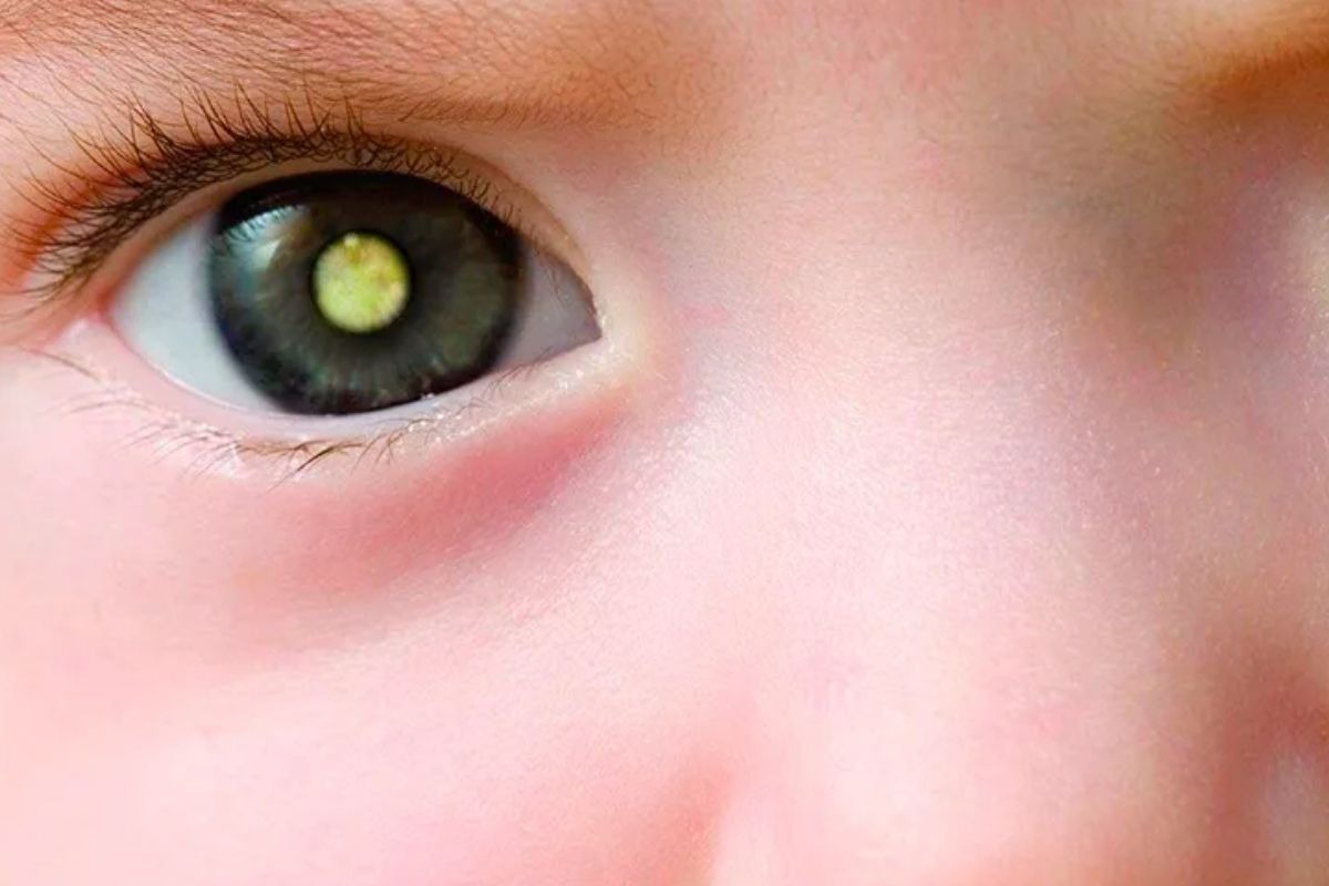 Tumor raro nos olhos surge principalmente em crianças pequenas. Retinoblastoma Entenda o câncer de Lua filha de Tiago Leifert Daiana Garbin