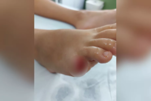 Criança de 10 anos tem o dedo arrancado por piranha em lago de Buriti Alegre