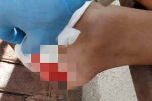 O Lago de Corumbá, situado na cidade de Caldas Novas, registrou o segundo caso de ataque de piranhas em uma semana. Dessa vez, um homem teve o calcanhar do pé mordido enquanto se banhava nas águas, por volta das 15h de sábado (5).